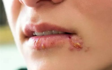 忽视嘴角水泡，女子不幸脑死亡：健康警示，不容忽视的细节